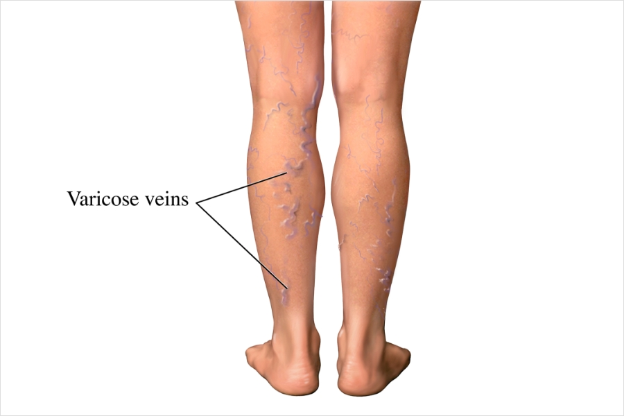 Varicose Veins Causes