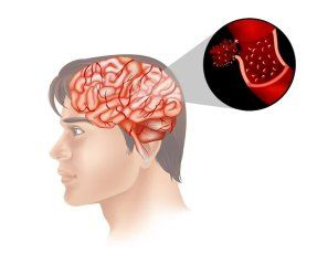 Advanced Non-Surgical Brain Stroke Treatment