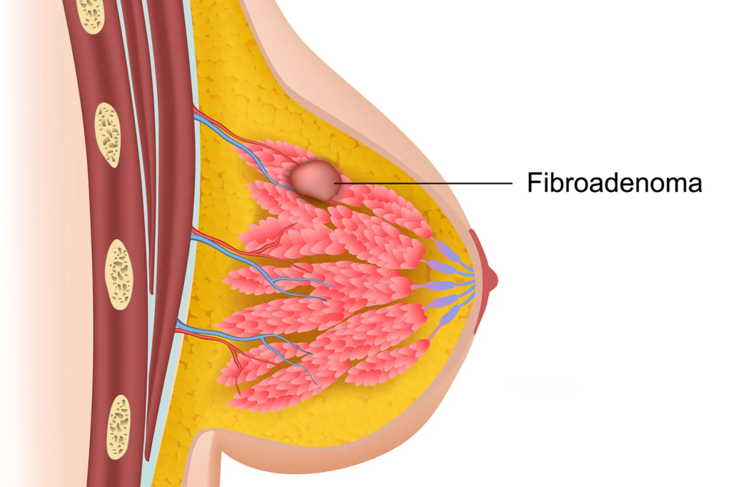 Breast Fibroadenoma