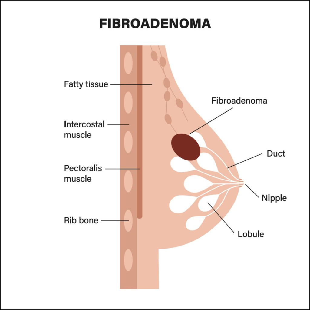 Breast Fibroadenoma