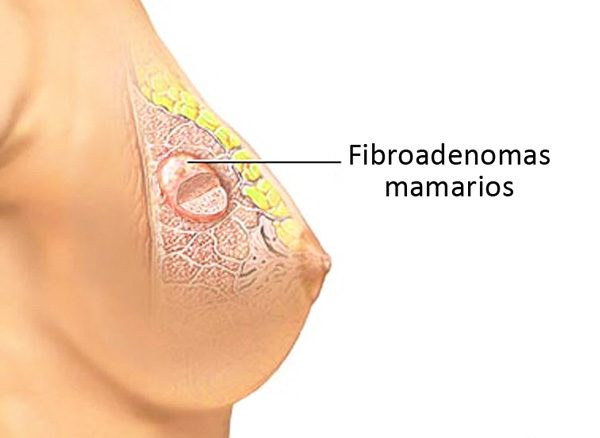 Best Doctor for Fibroadenoma Removal Near Me