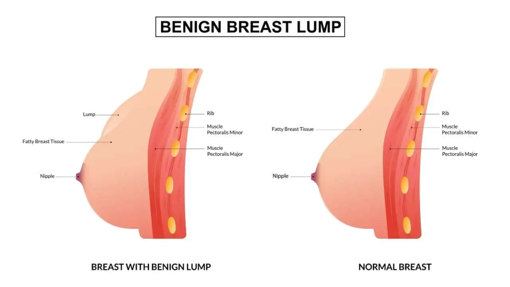 Breast Lump