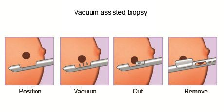 Vacuum Assisted Biopsy