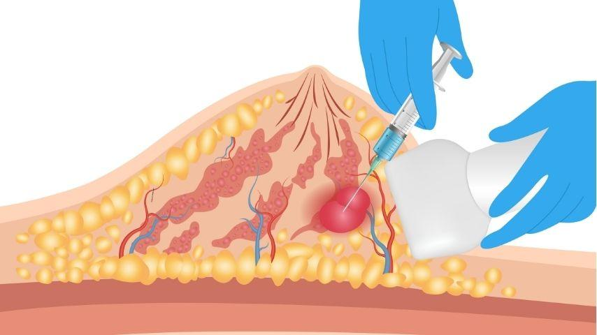 Vacuum Assisted Biopsy
