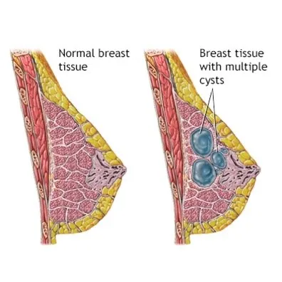 Vacuum Assisted Biopsy