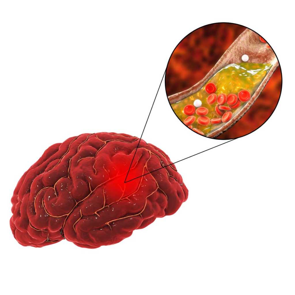 Top Stroke Treatment Specialist Near Me for Fast Recovery Care 2 Top Stroke Treatment Specialist Near Me