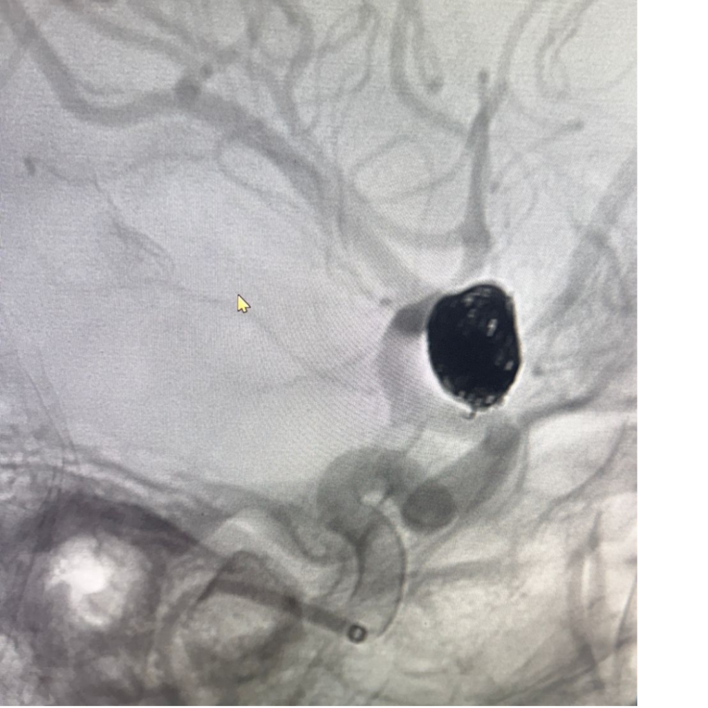 Internal Carotid Artery Aneurysm Coiling