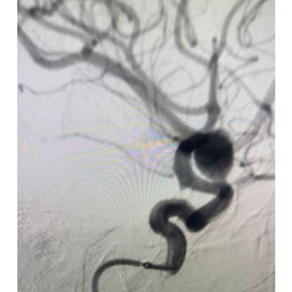 Internal Carotid Artery Aneurysm Coiling