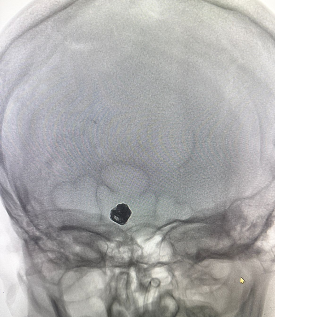 Internal Carotid Artery Aneurysm Coiling