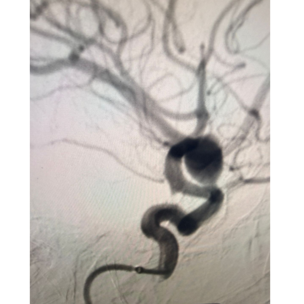 Internal Carotid Artery Aneurysm Coiling