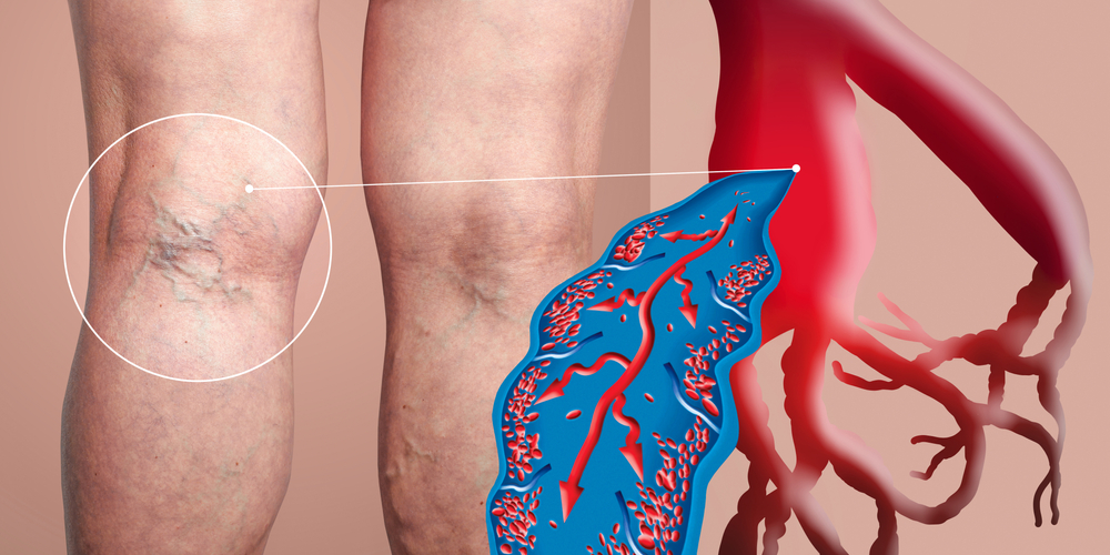 DVT