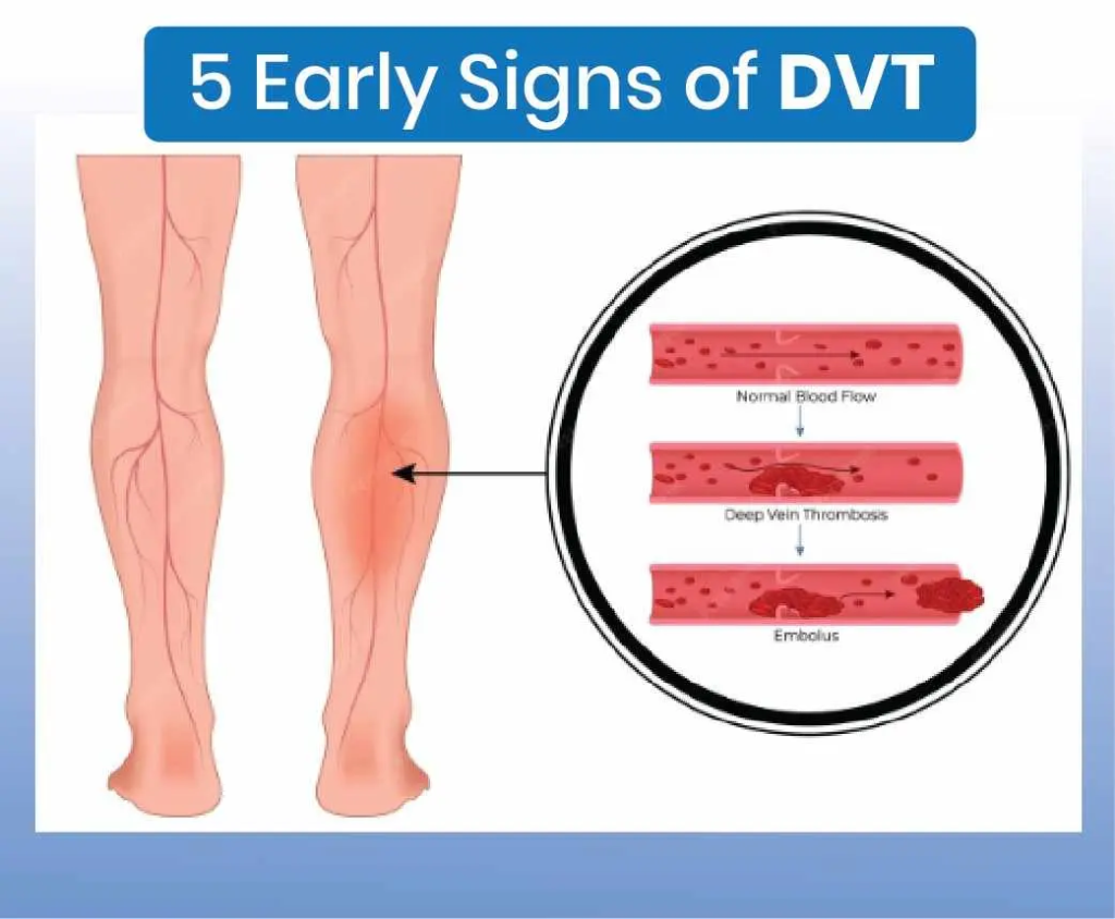 DVT