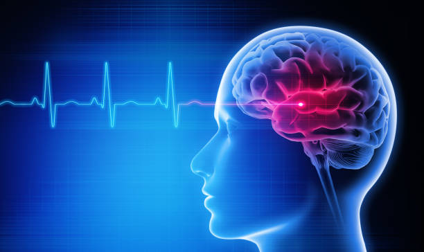 neuro doctor for stroke treatment