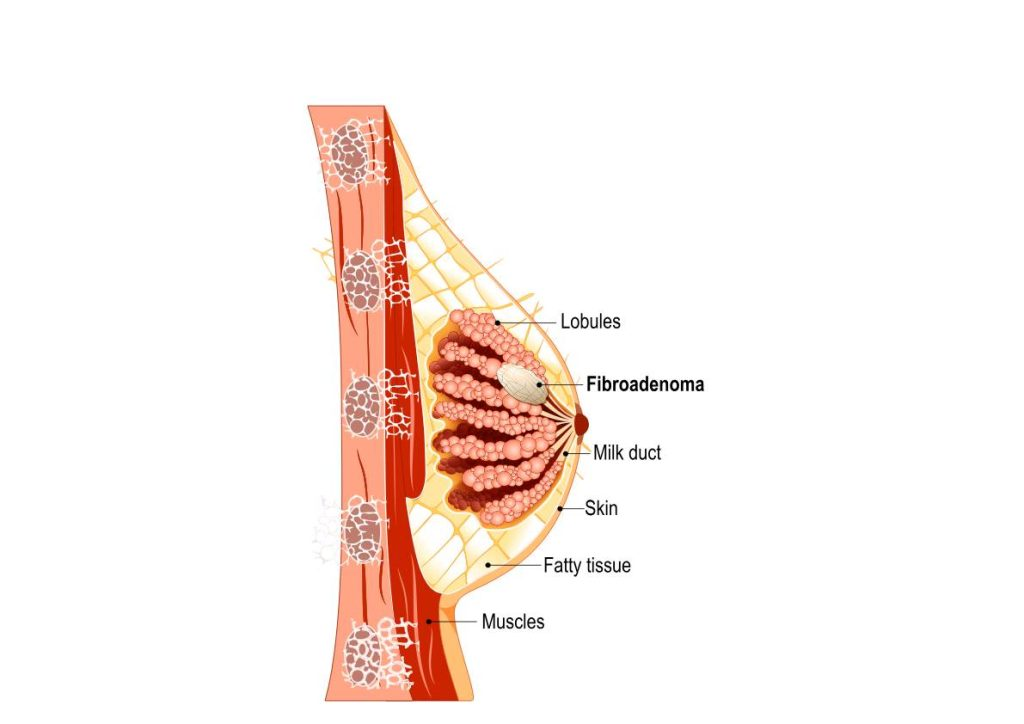 Breast Fibroadenoma Treatment