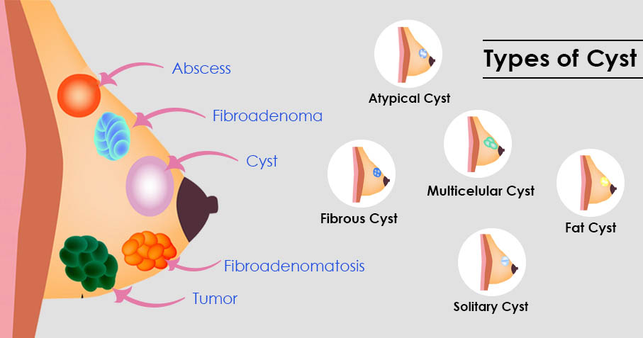 Breast Fibroadenoma Treatment