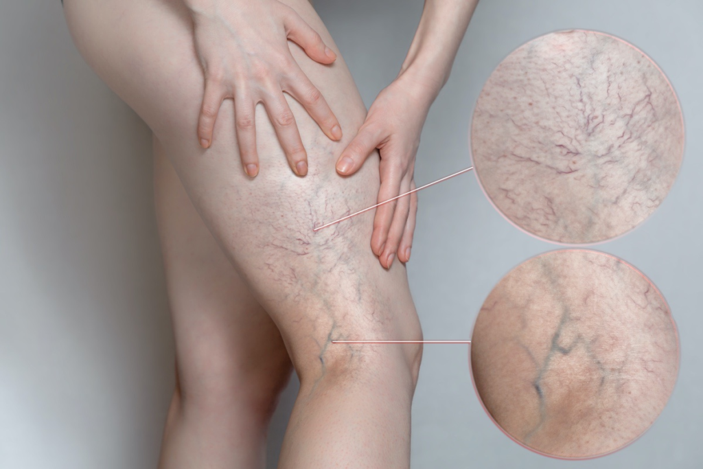 Varicose Veins: Causes, Symptoms & The Best Non-Surgical Treatments in 2026 2 Varicose Veins