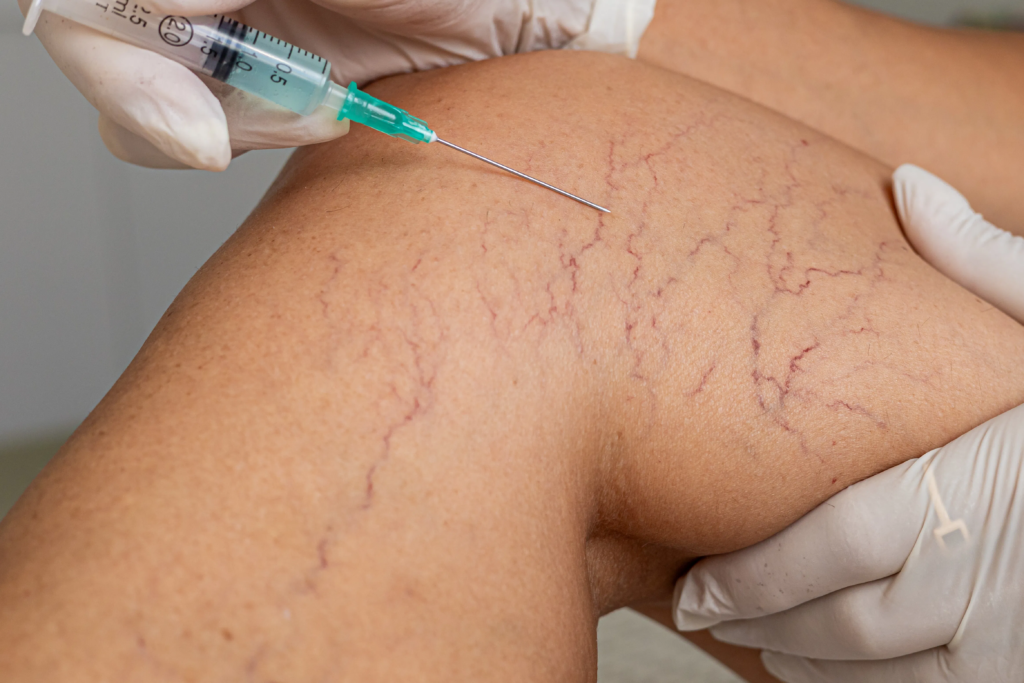 Varicose Veins: Causes, Symptoms & The Best Non-Surgical Treatments in 2026 3 Varicose Veins