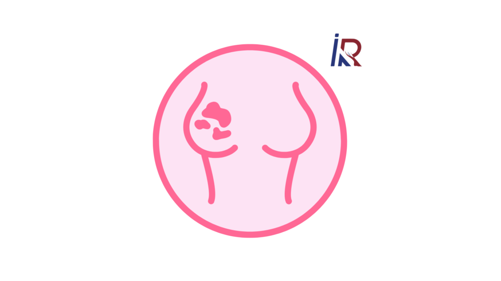Say Goodbye to Breast Lumps