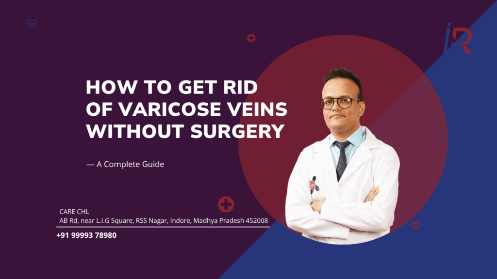 How to Get Rid of Varicose Veins Without Surgery — A Complete Guide