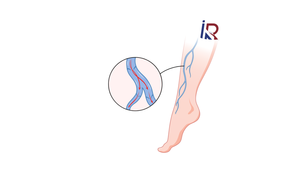 Varicose Veins Varicose Veins