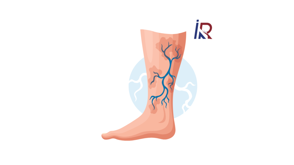 Varicose Veins Varicose Veins