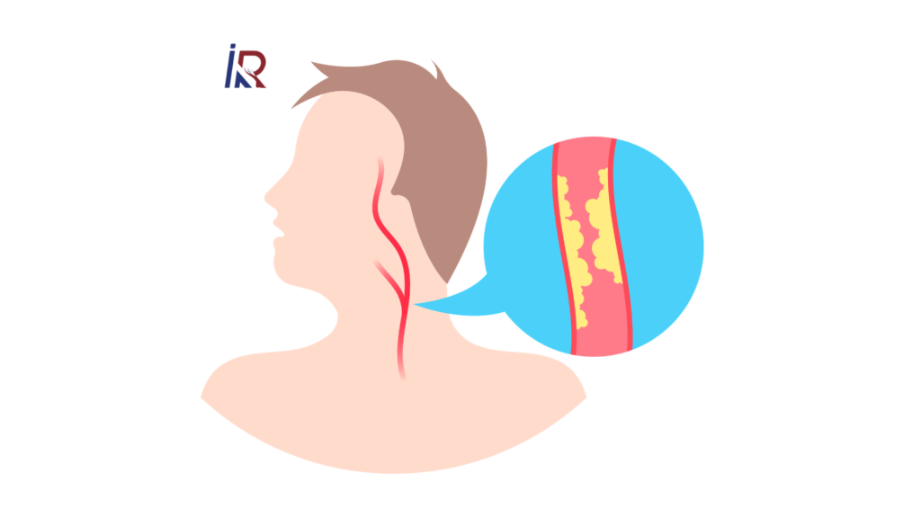Blocked Neck Artery: Causes, Symptoms, Stroke Risk & Treatment Explained