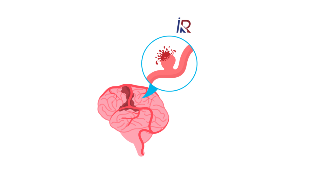 What Is a Brain Aneurysm? Signs You Should Never Ignore