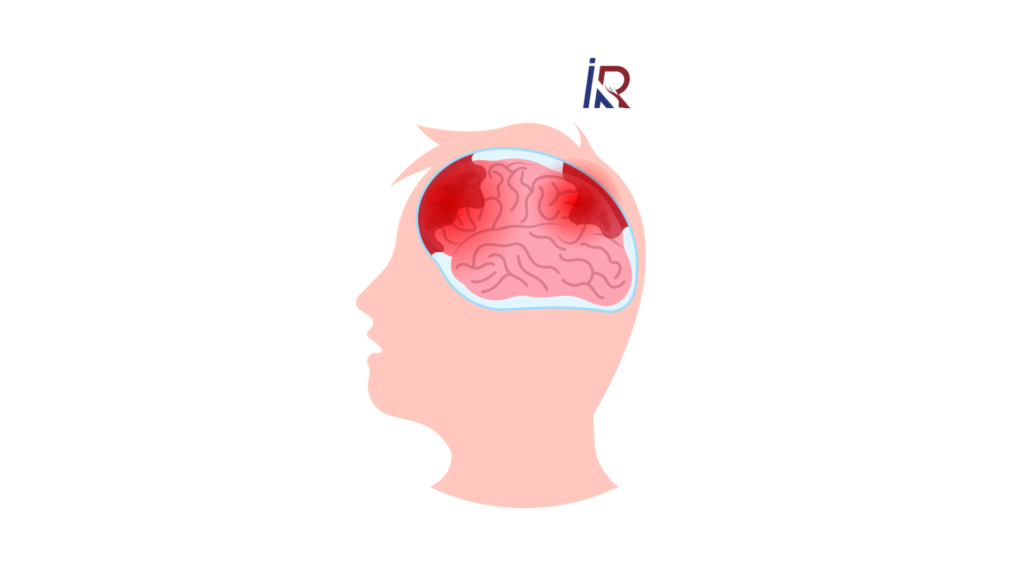 What Is a Brain Aneurysm? Signs You Should Never Ignore