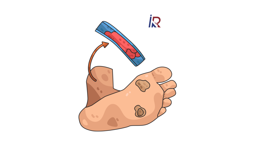 How to Save a Diabetic Foot From Amputation | Modern Minimally Invasive Solutions