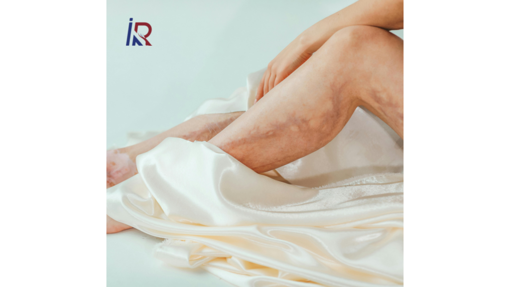 Top 7 Myths About Varicose Veins You Should Stop Believing