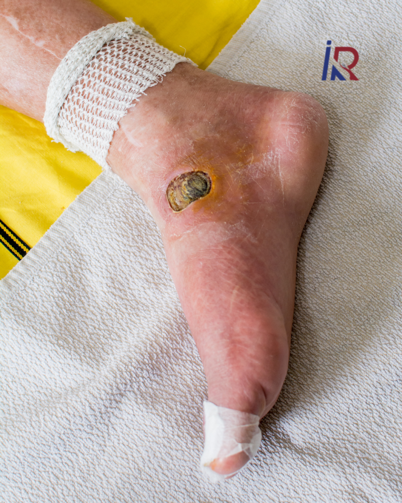 Save Limb, Save Life: How Diabetic Foot Ulcers Are Treated Without Amputation 1 Save Limb, Save Life: How Diabetic Foot Ulcers Are Treated Without Amputation