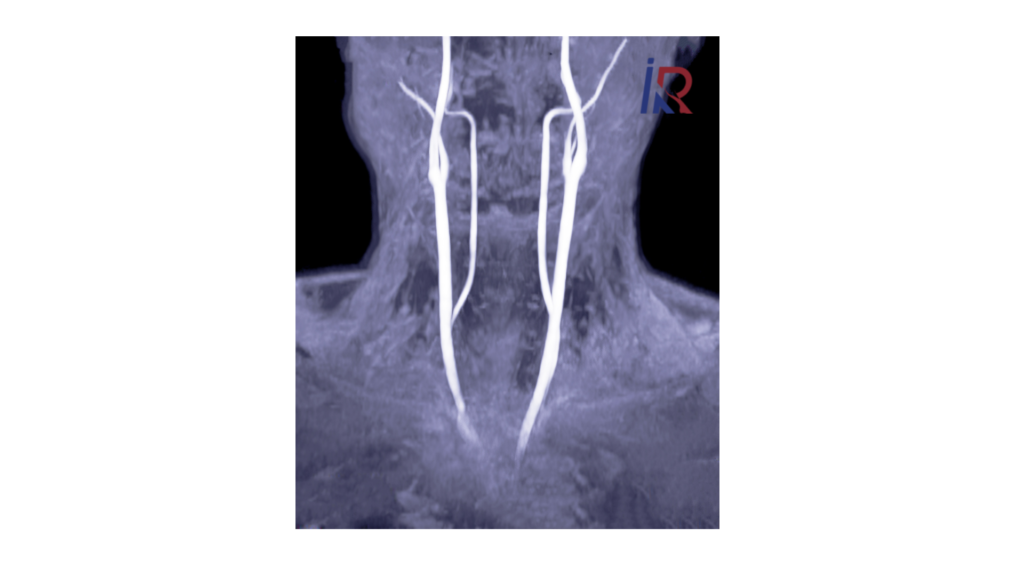 What Is an Internal Carotid Artery Aneurysm? | Simple Guide 1 What Is an Internal Carotid Artery Aneurysm?