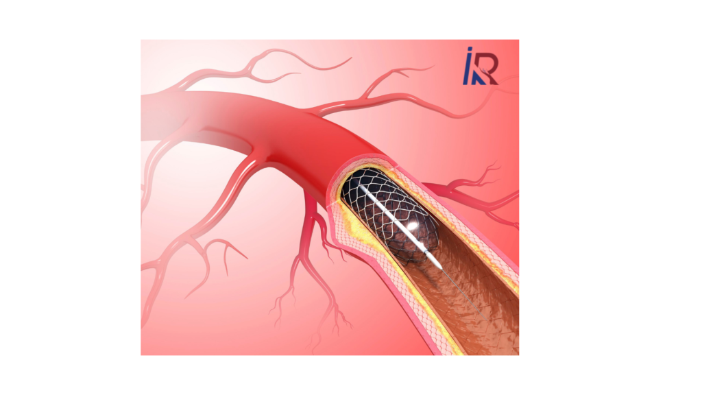 What Is an Internal Carotid Artery Aneurysm? | Simple Guide 2 What Is an Internal Carotid Artery Aneurysm?