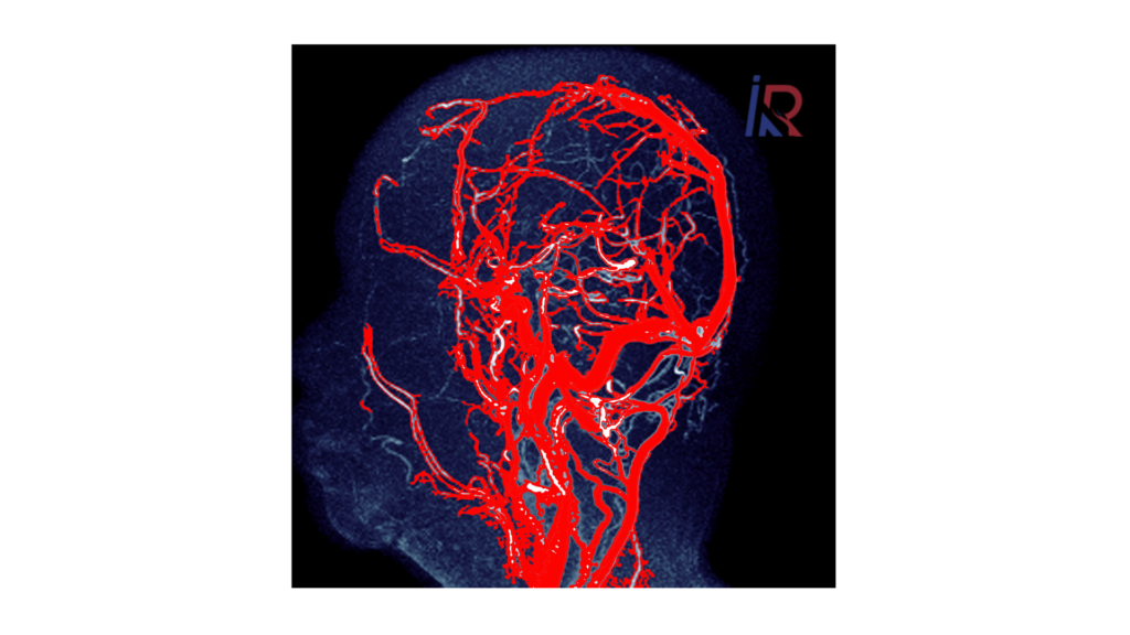 What Is an Internal Carotid Artery Aneurysm? | Simple Guide 3 What Is an Internal Carotid Artery Aneurysm?