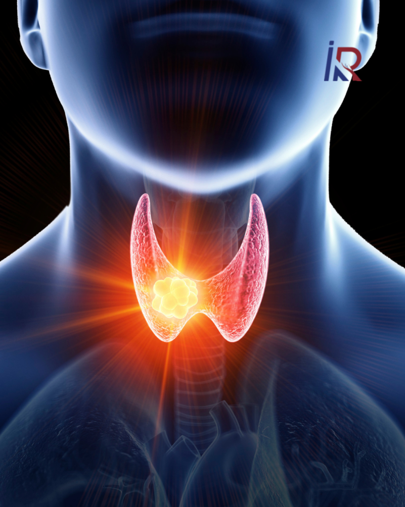 Thyroid Nodules Can Now Be Treated Without Big Surgery: A Simple Guide 1 Thyroid Nodules Can Now Be Treated Without Big Surgery