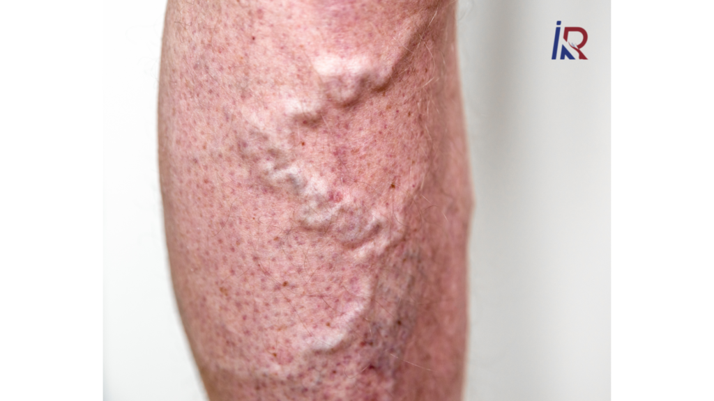 Top 7 Myths About Varicose Veins You Should Stop Believing