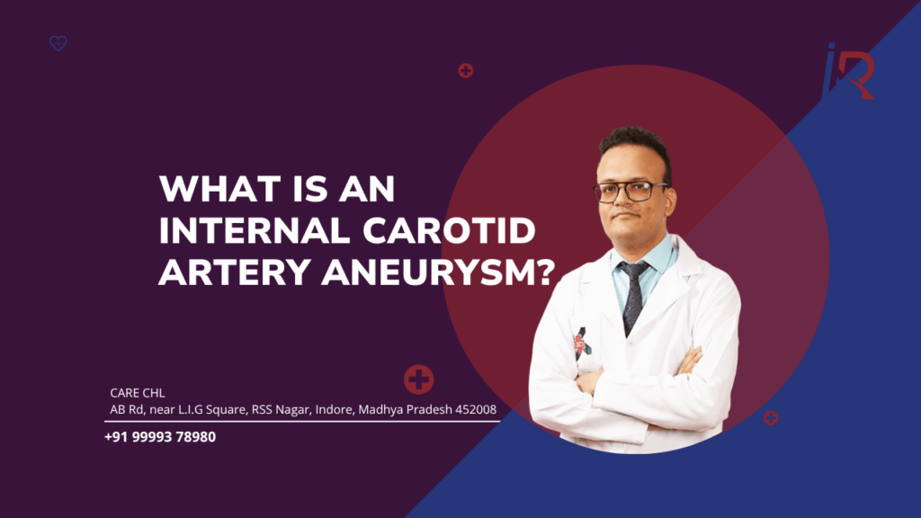 What Is an Internal Carotid Artery Aneurysm? | Simple Guide