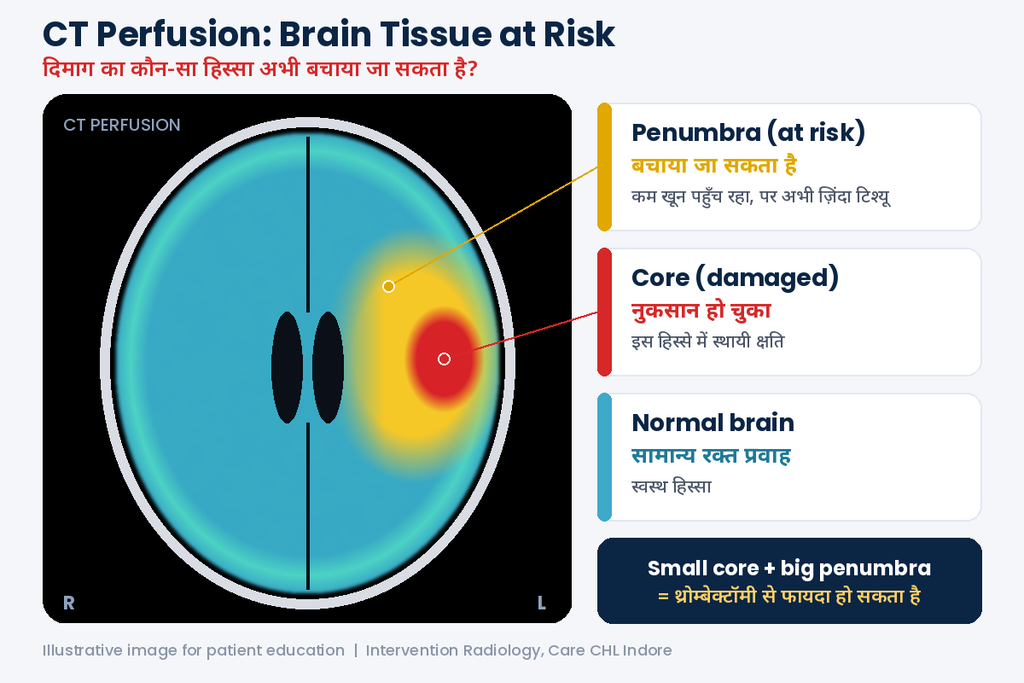CT perfusion scan for stroke during sleep