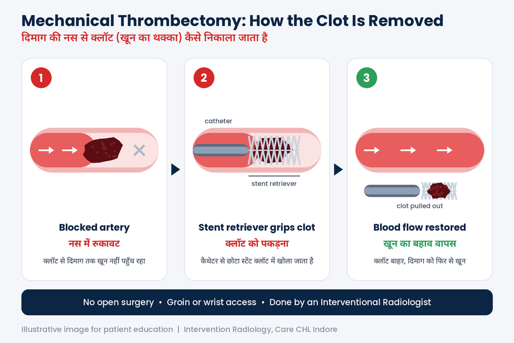 Mechanical thrombectomy by interventional radiologist in Indore