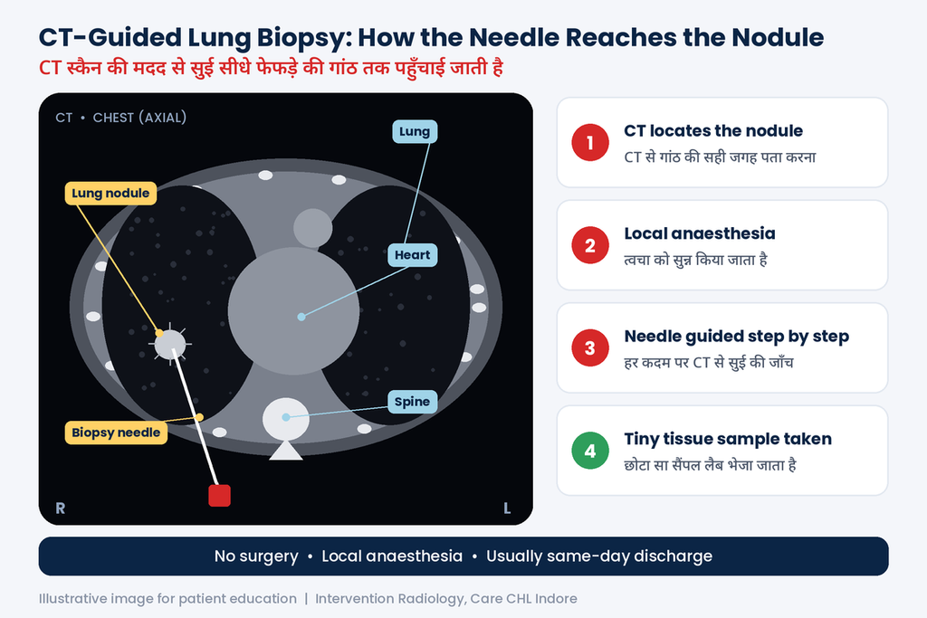 Illustration of needle entering lung nodule under CT guidance

