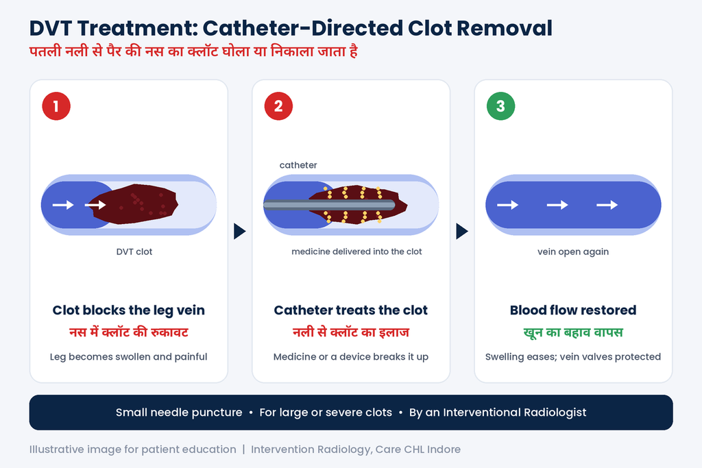 DVT clot removal by interventional radiologist in Indore