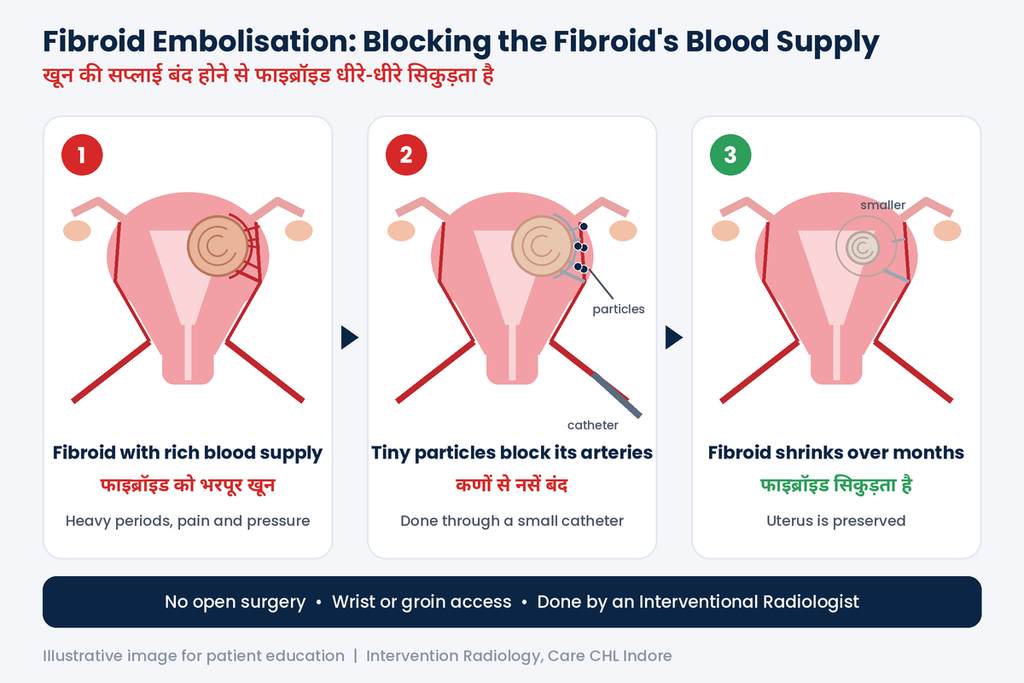 How Your Periods May Change After Fibroid Embolisation 1 Fibroid embolisation in Indore by interventional radiologist