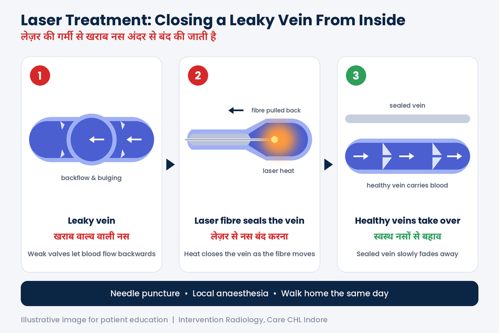 Why Varicose Veins Can Return After Laser Treatment 2 Laser treatment for varicose veins in Indore