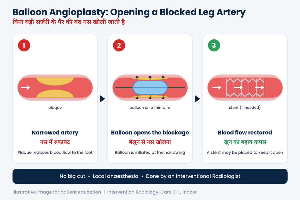 Angioplasty for poor blood circulation in the feet in Indore