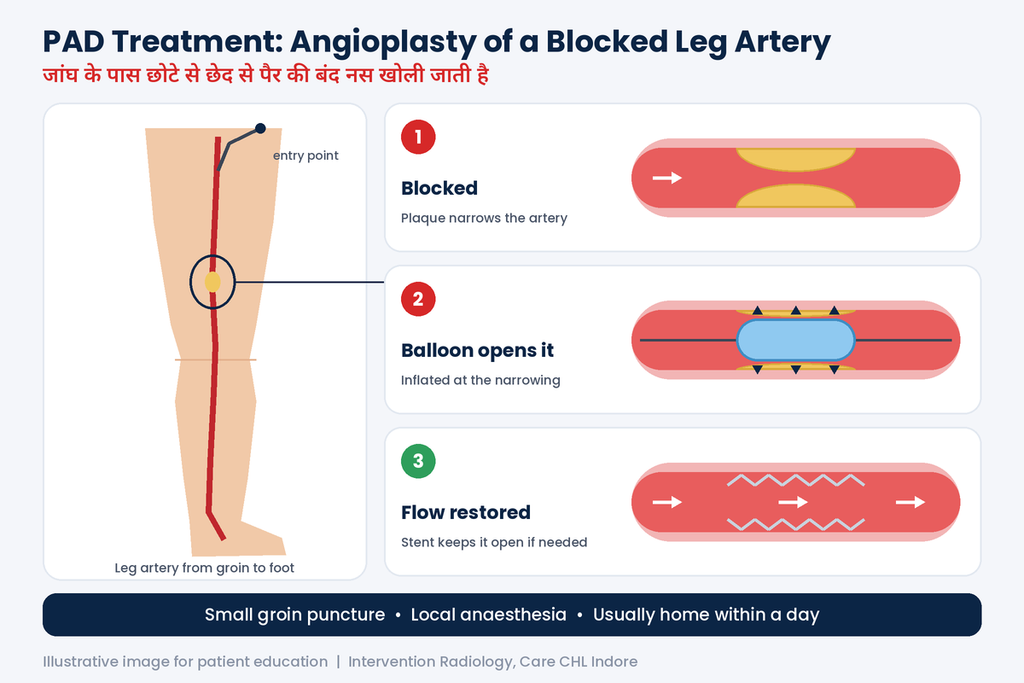 Risk factors for PAD without diabetes