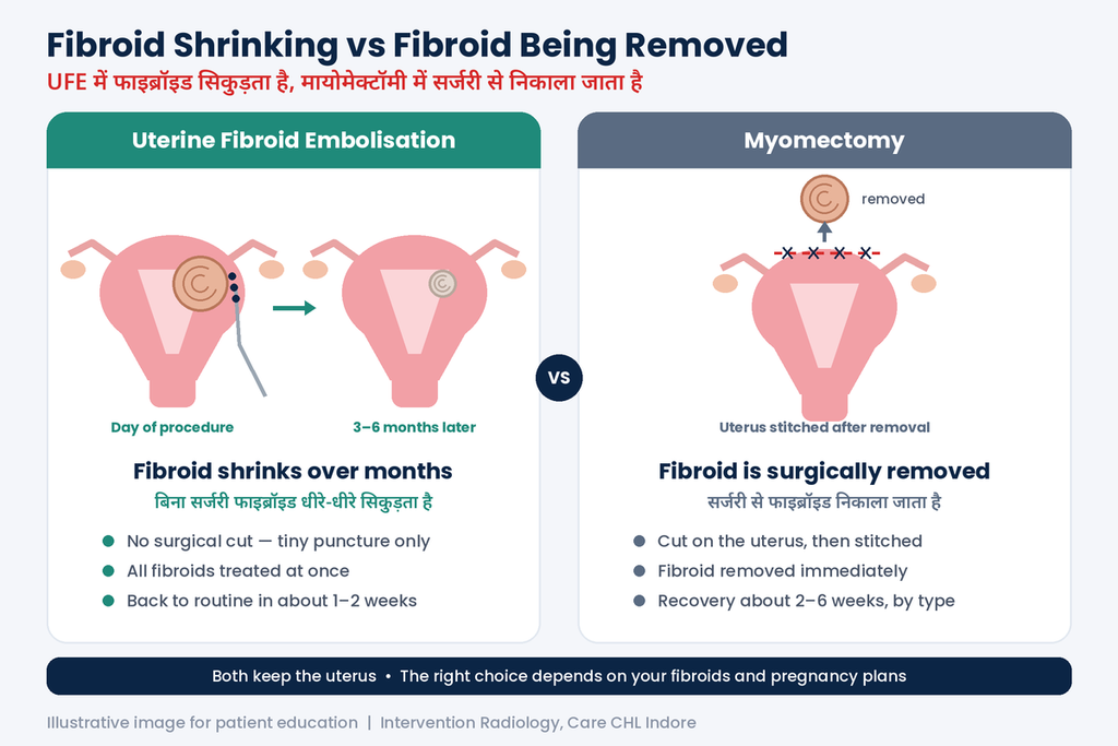 How uterine fibroid embolisation and myomectomy work
