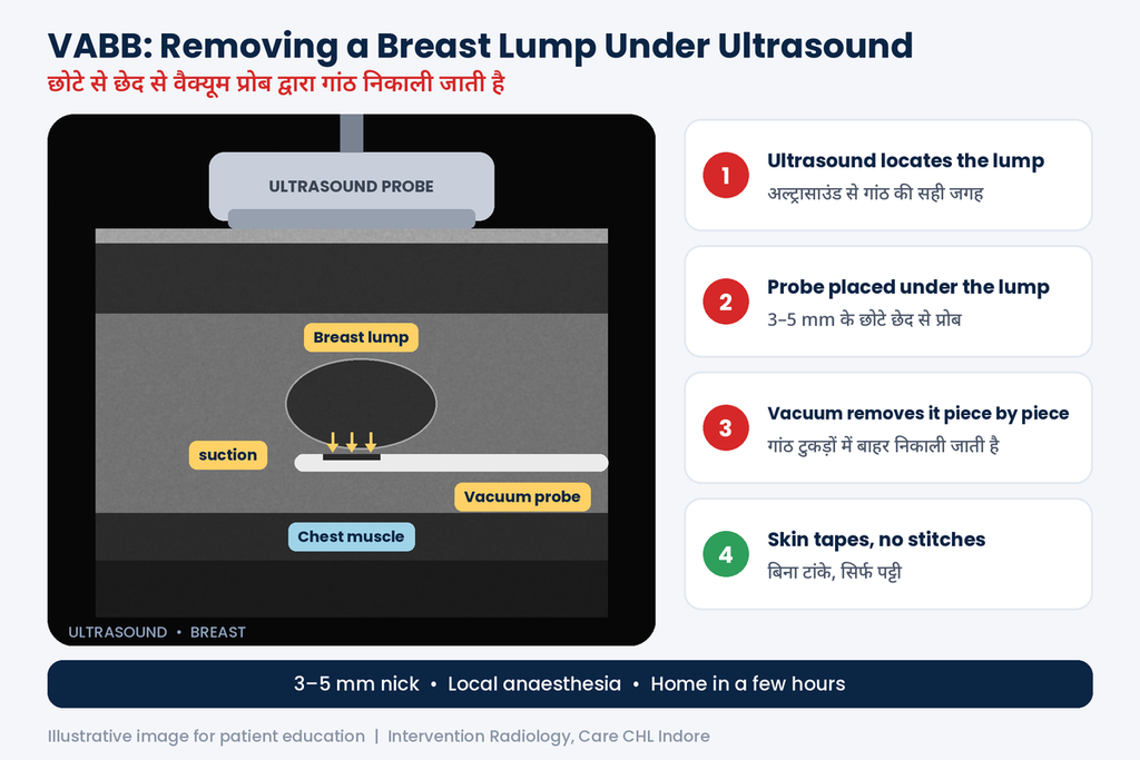 VABB Breast Lump Removal in Indore: Scar-Free Removal Without Surgery 1 VABB procedure for breast lump removal