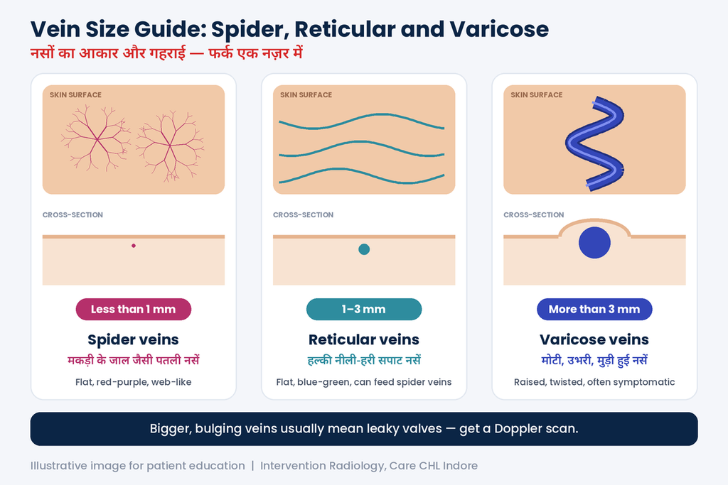 Difference between spider veins and varicose veins